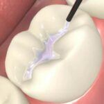 The Benefits of Dental Sealants: Protecting Your Teeth from Decay